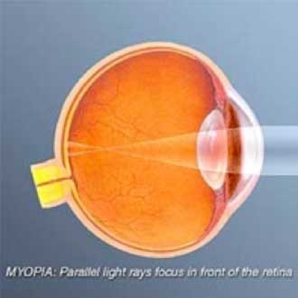 Nearsightedness,-or-myopia