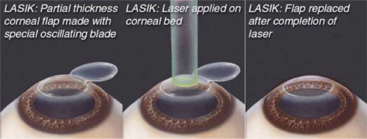 What-is-LASIK-What-is-LASIK-